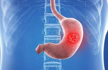 日本修訂胃癌治療指南 ：針對早期胃癌的ESD / EMR治療