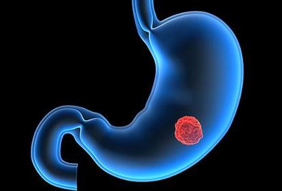日本專家談晚期胃癌的化療選擇